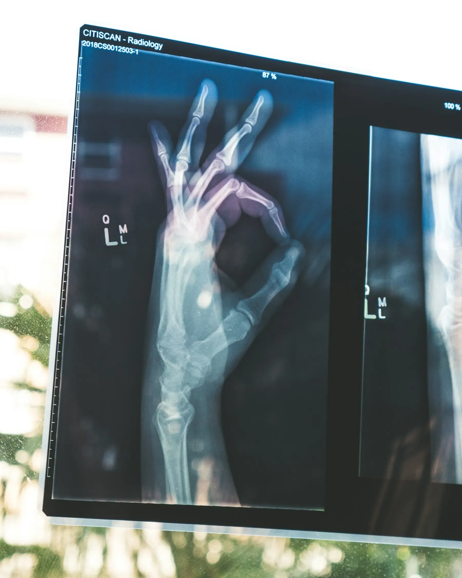 Pantalla de radiología mostrando imagen diagnóstica de una mano, Fase 0 de valoración